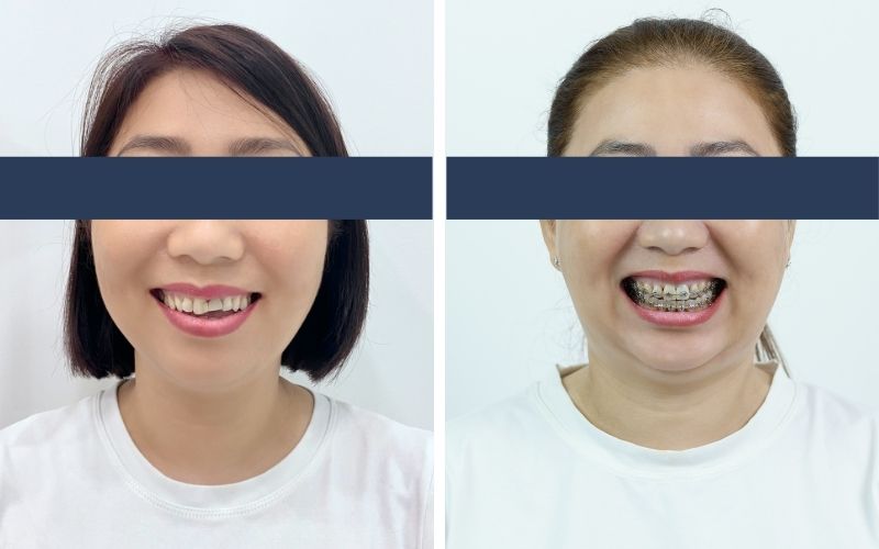 40 Tuổi Có Niềng Răng Được Không