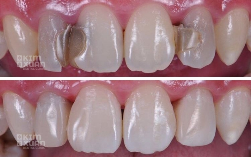 Ảnh Trước Và Sau Khi Trám Răng Tại Nha Khoa Kim Xuân