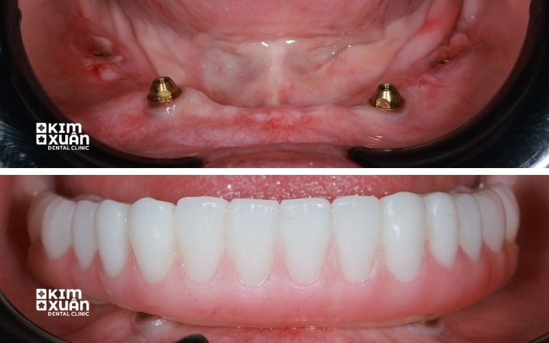 Ảnh Trước Và Sau Khi Trồng Răng Implant