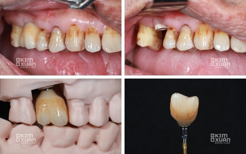 Cấy Ghép Implant