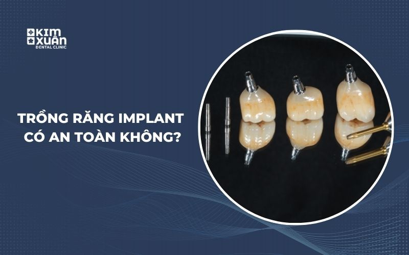 Cấy Ghép Implant Có An Toàn Không