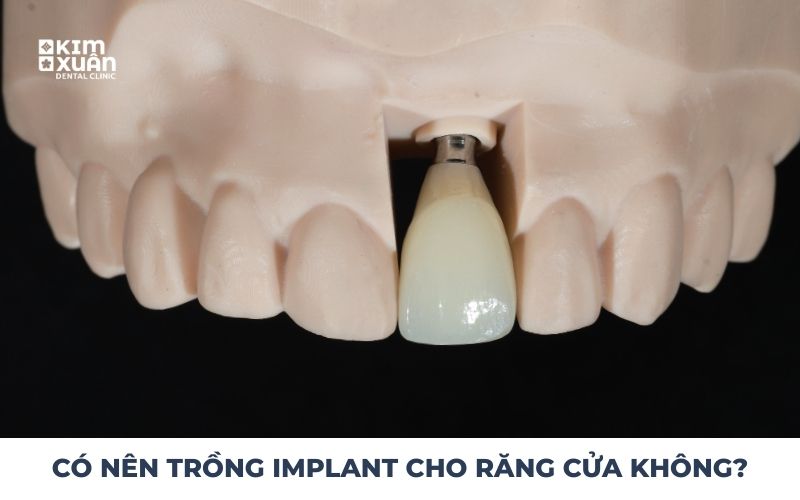 Có Nên Trồng Răng Implant Răng Cửa Không