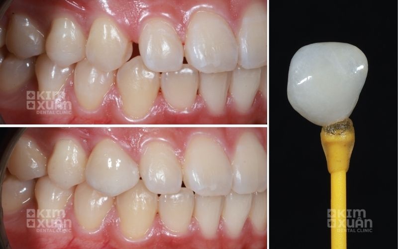 Dán Sứ Veneer Giá Bao Nhiêu