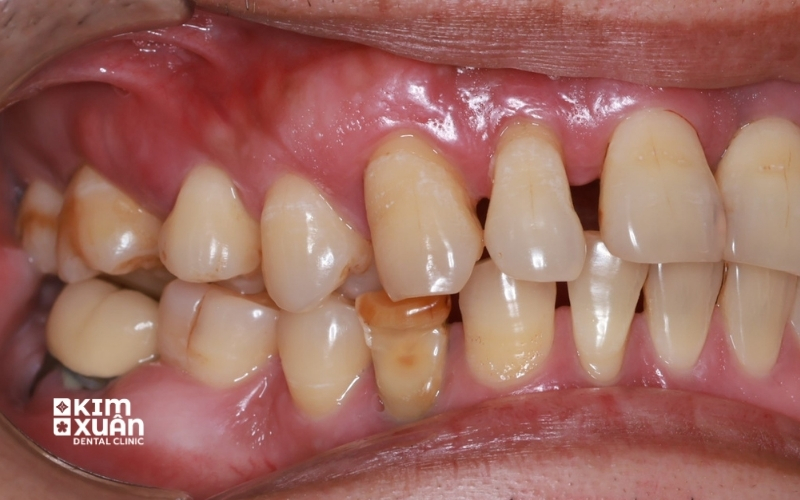 Dấu Hiệu Nhận Biết Răng Bị Viêm Nha Chu