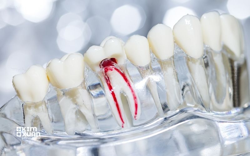 Điều Trị Tủy Răng Là Gì?