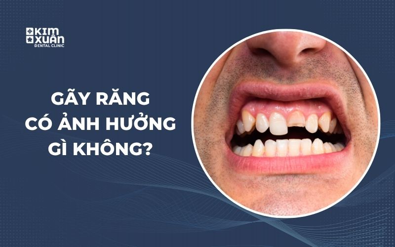 Gãy Răng Có Sao Không
