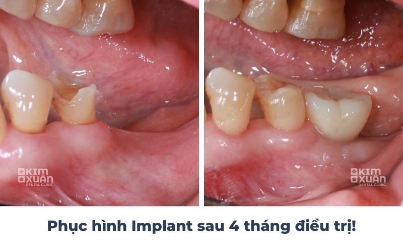 Hình Ảnh Trước Và Sau Cấy Ghép Implant Sau 4 Tháng