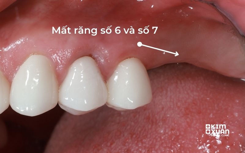 Hình Ảnh Mất Răng Hàm Gây Hóp Má