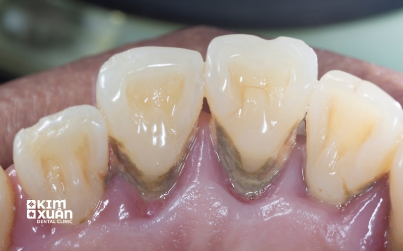 Hình Ảnh Răng Bị Viêm Nha Chu