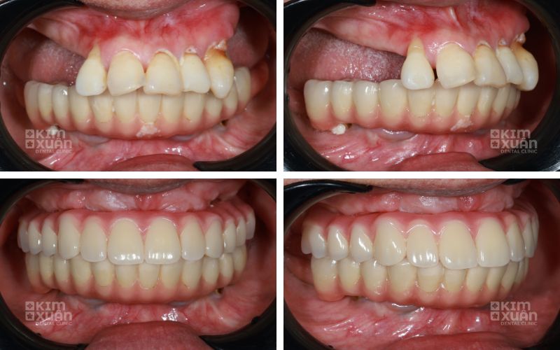 Hình Ảnh Trước Và Sau Khi Khắc Phục Răng Hàm Bị Mất