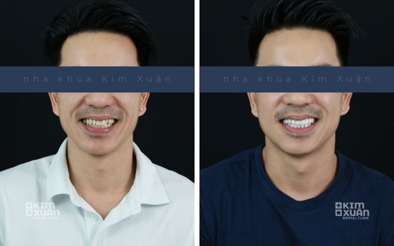 Hình Ảnh Trước Và Sau Khi Dán Sứ Veneer Tại Nha Khoa Kim Xuân
