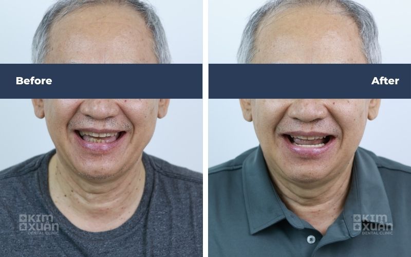 Hình Ảnh Trước Và Sau Khi Khắc Phục Răng Hàm Bị Mất Tại Nha Khoa Kim Xuân