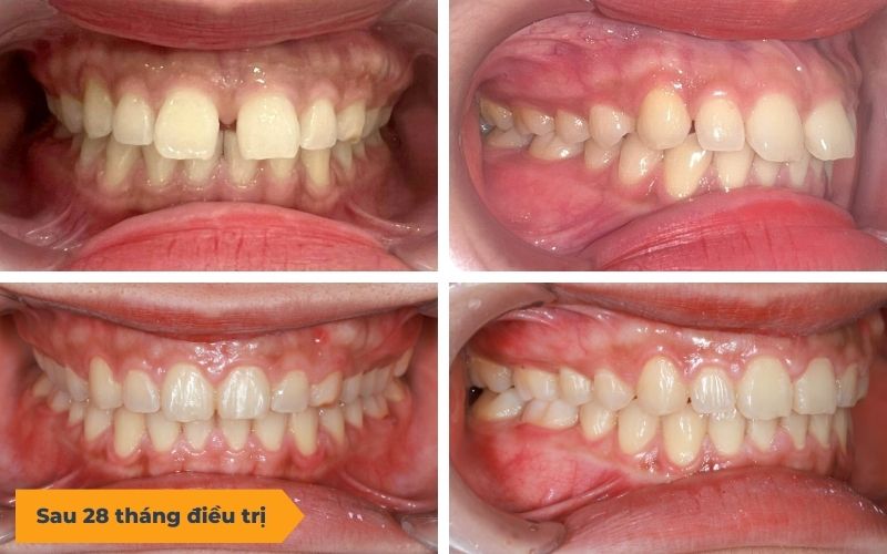 Hình Ảnh Trước Và Sau Khi Niềng Răng Ở Tuổi 40