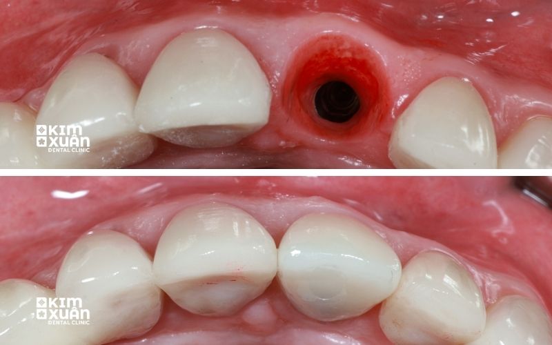 Hình Ảnh Trước Và Sau Khi Trồng Implant Răng Cửa