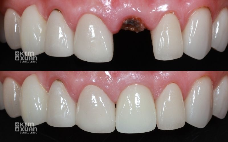 Hình Ảnh Trước Và Sau Khji Trồng Implant Răng Cửa Tại Nha Khoa Kim Xuân