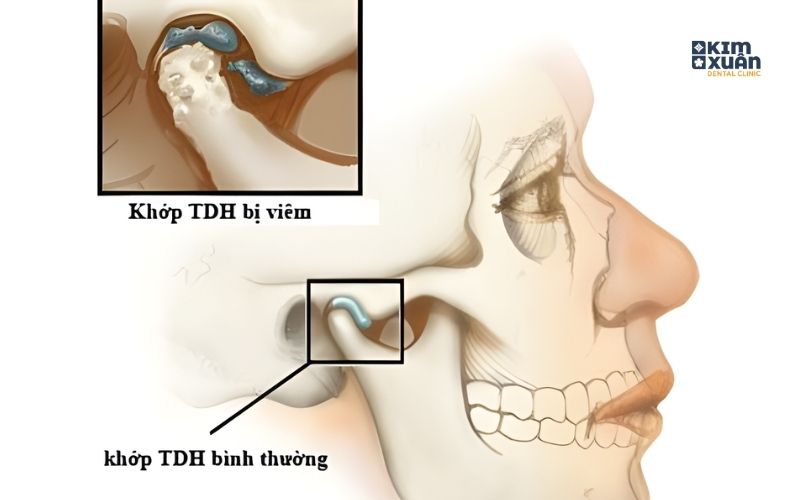 Hình Ảnh Viêm Khớp Thái Dương Hàm