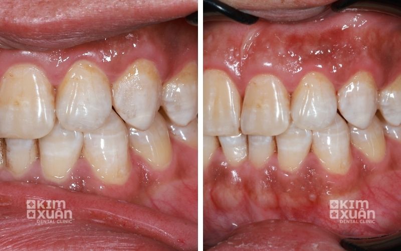 Hình Ảnh Viêm Nướu Răng