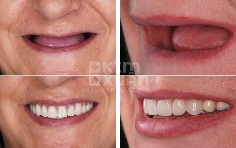 Hình trước và sau phục hình răng mất bằng răng giả tháo lắp.