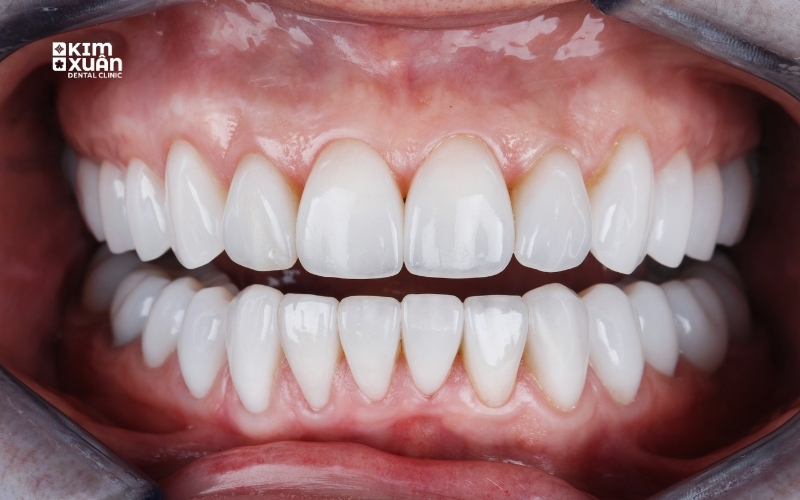 Khi Nào Nên Bọc Răng Sứ