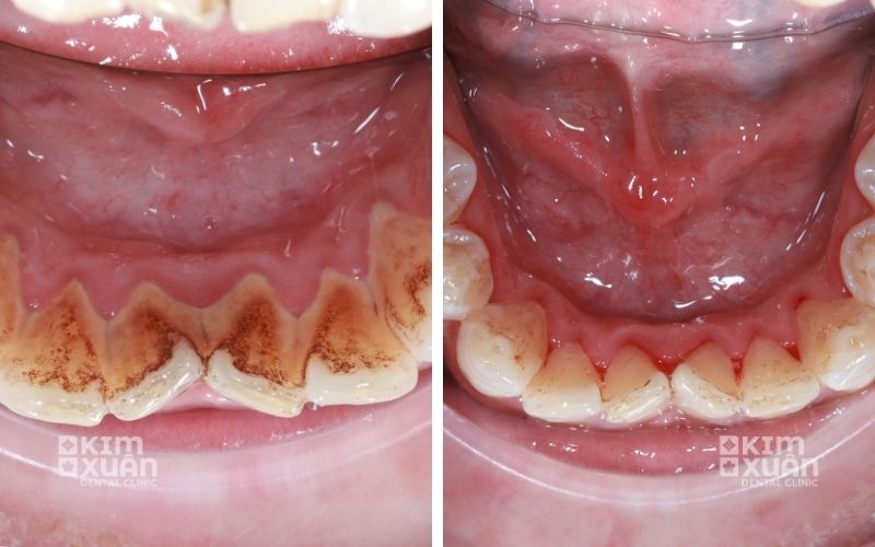 Hình ảnh trước và sau khi lấy cao răng hàm dưới tại phòng khám nha khoa