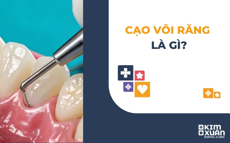 Lấy Cao Răng Nha Khoa Kim Xuân