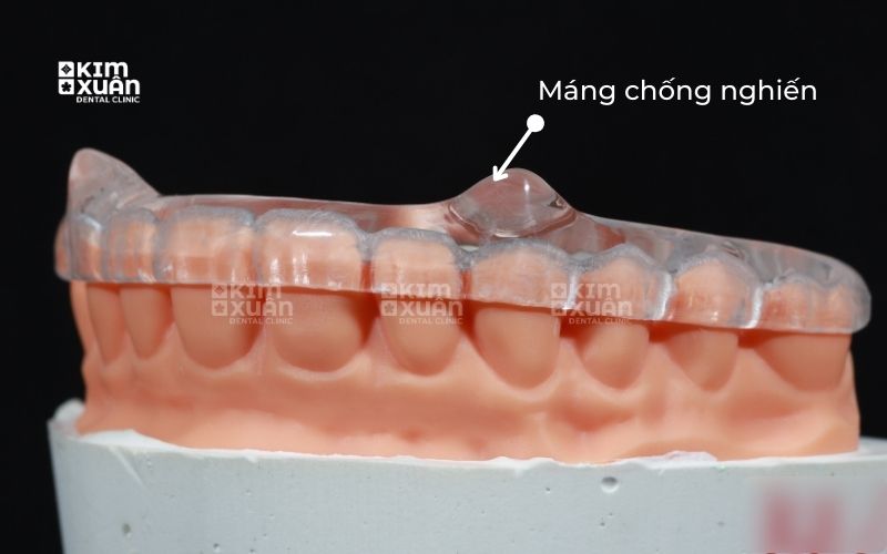 Máng Chống Nghiến Răng Khi Ngủ