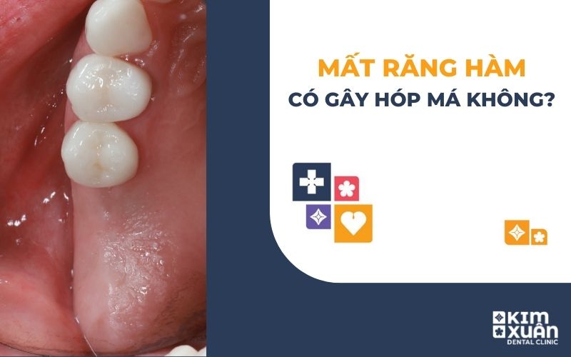 Mất Răng Hàm Có Gây Hóp Mà Không