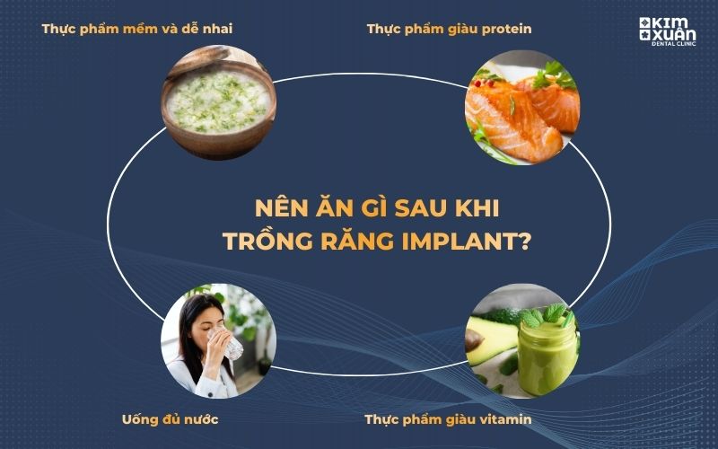 Nên Ăn Gì Sau Khi Trồng Răng Implant