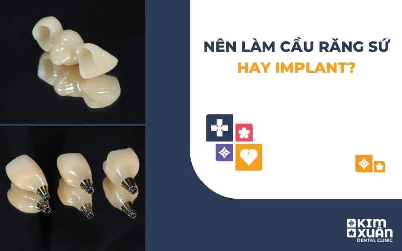 Nên Làm Cầu Răng Sứ Hay Implant