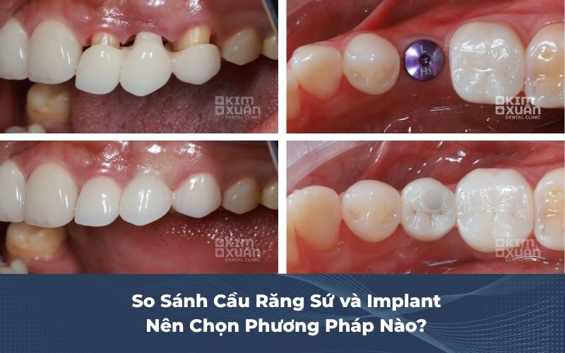 Nên Làm Cầu Răng Sứ Hay Trồng Răng Implant