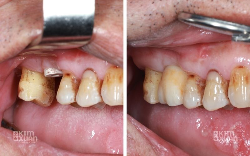 Người Hút Thuốc Lá Có Trồng Răng Implant Được Không