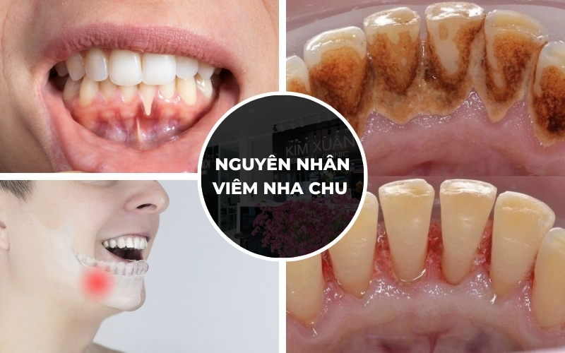 Nguyên Nhân Gây Bệnh Viêm Nha Chu