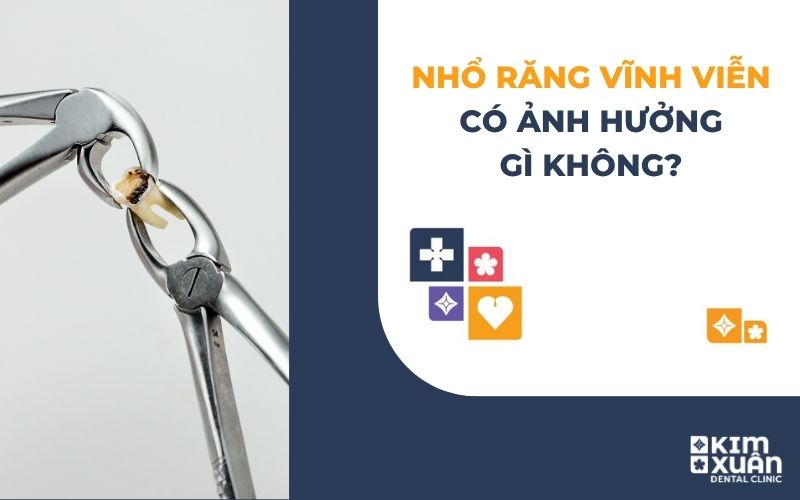 Nhổ Răng Vĩnh Viễn