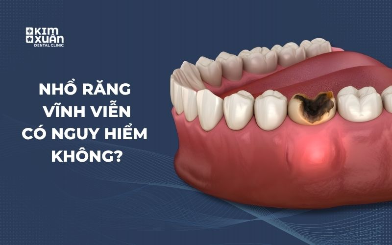 Nhổ Răng Vĩnh Viễn Có Sao Không