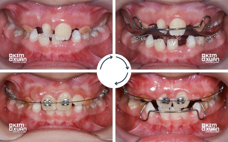 Niềng Răng Cho Trẻ 8 Tuổi Tại Nha Khoa Kim Xuân