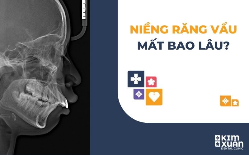 Niềng Răng Vẩu Mất Bao Lâu