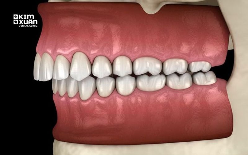 Niềng Răng Vẩu Mất Thời Gian Bao Lâu