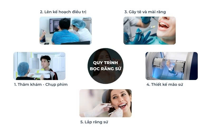 Quy Trình Bọc Răng Sứ Chuẩn Y Khoa 