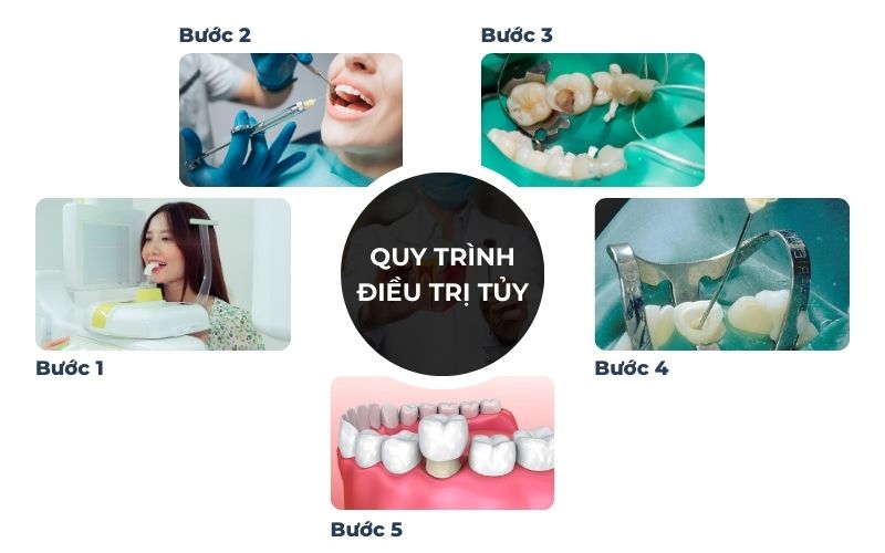 Quy Trình Lấy Tủy Răng Chuẩn Y Khoa Tại Nha Khoa Kim Xuân