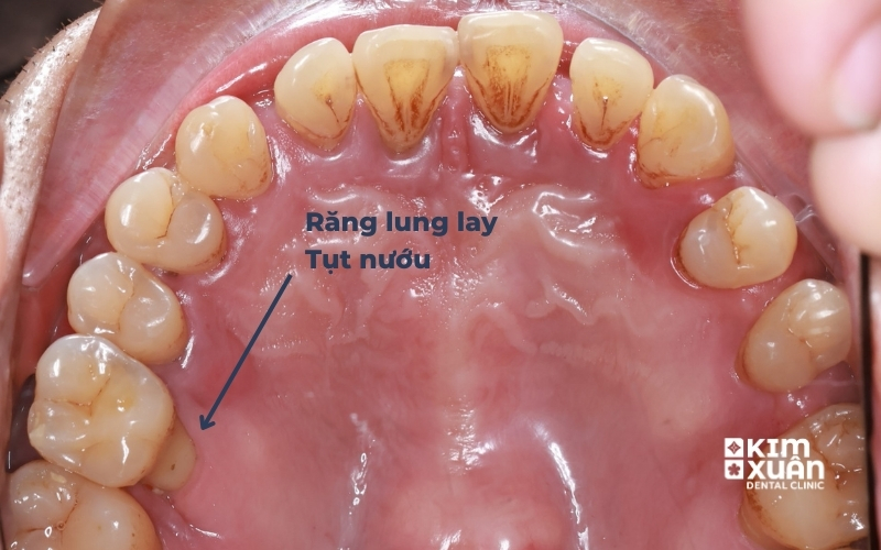 Răng Bị Lung Lay Do Viêm Nha Chu