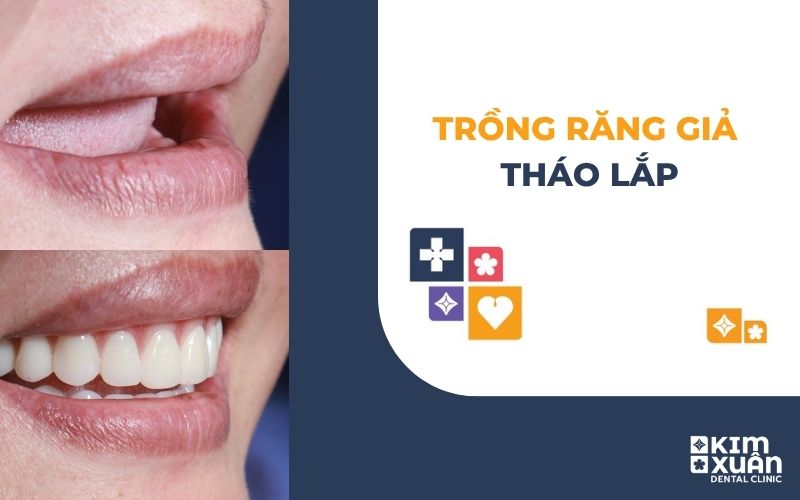 Răng Giả Tháo Lắp Là Gì