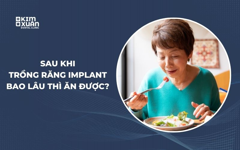 Sau Khi Trồng Răng Implant Bao Lâu Thì Ăn Được