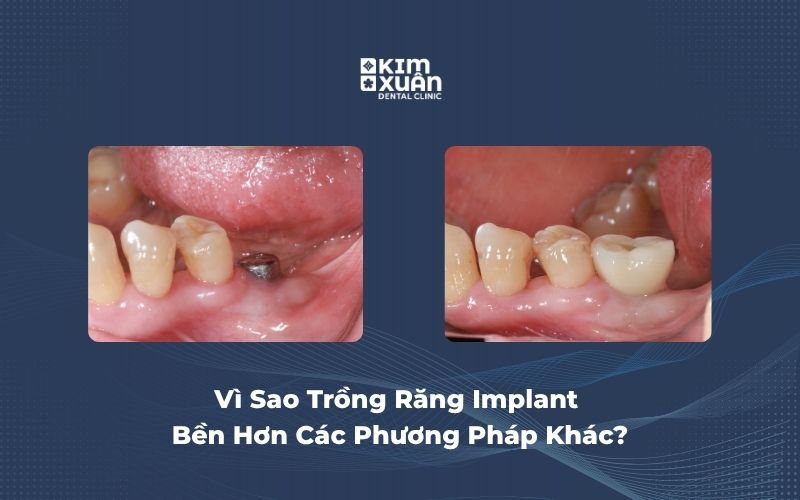 So Sánh Trồng răng Implant Với Cầu Răng Sứ