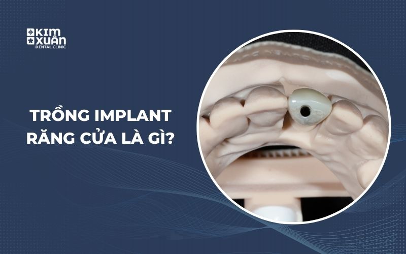 Trồng Implant Răng Cửa