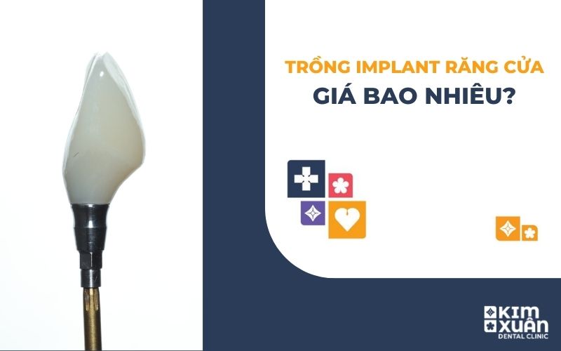 Trồng Implant Răng Cửa Giá Bao Nhiêu Tiền 