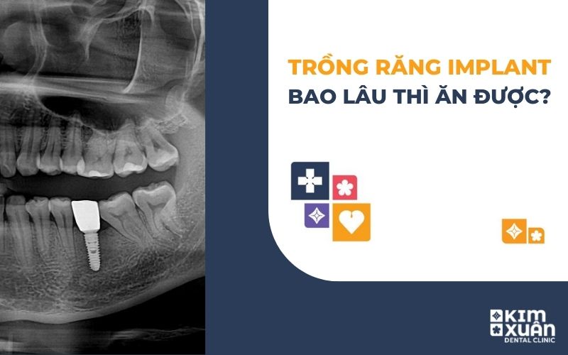 Trồng Răng Implant Bao Lâu Thì Ăn Được