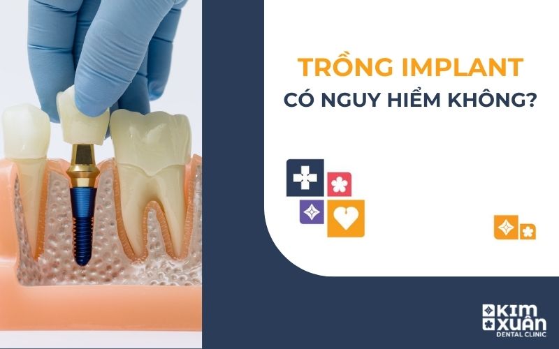 Trồng Răng Implant Có Nguy Hiểm Không