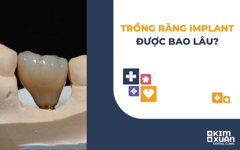 Trồng Răng Implant Được Bao Lâu