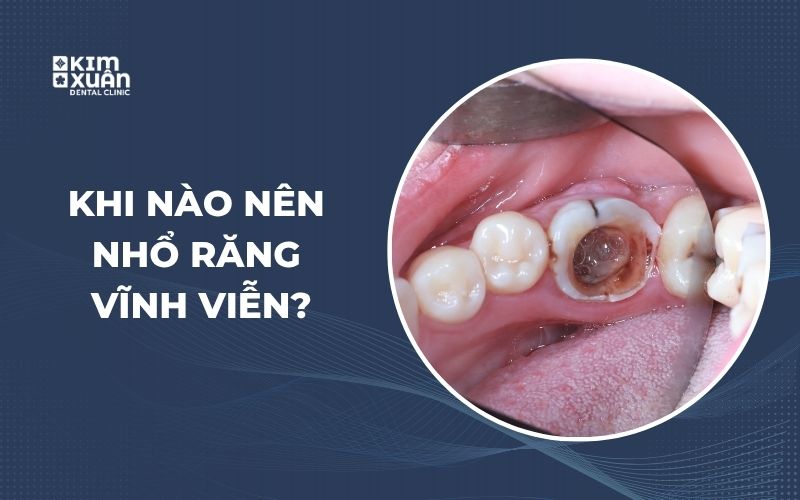 Trường Hợp Nên Nhổ Răng Vĩnh Viễn