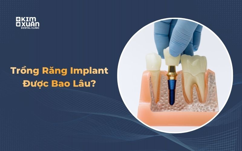 Tuổi Thọ Implant Được Bao Lâu